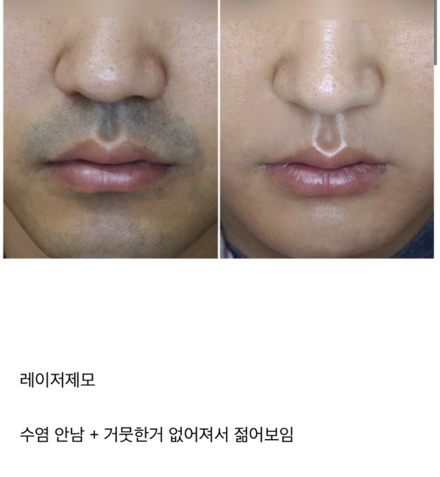 남자들이 절대 후회 안 하는 시술 원탑